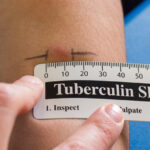 БЦЖ та Манту: у чому різниця?